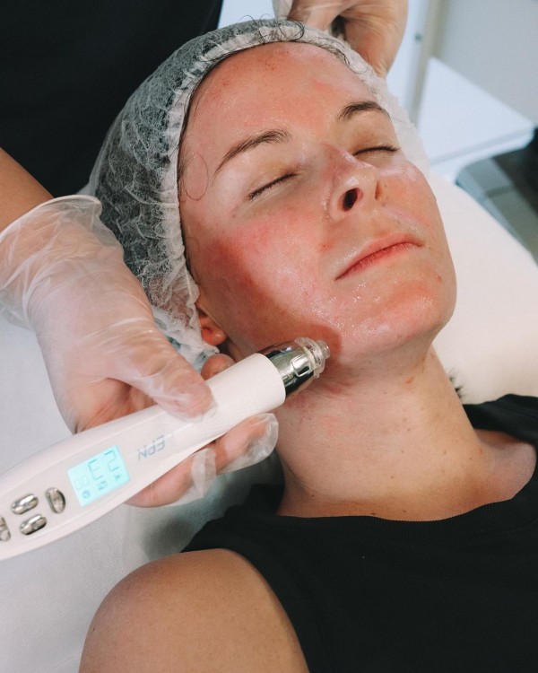 microneedling treatment